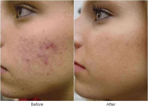 Acne Scar Treatment & Facial Skin Treatments in St. Louis