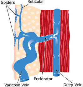 Cause of Varicose Veins