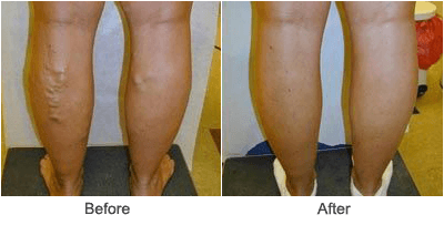 Endovenus Abalation: Laser Varicose Vein Treatment Beore & After