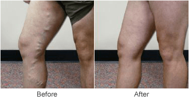 Laser Vein Treatment Services for Varicose Veins in St. Louis