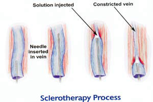 Sclerotherapy Vein Treatment Process