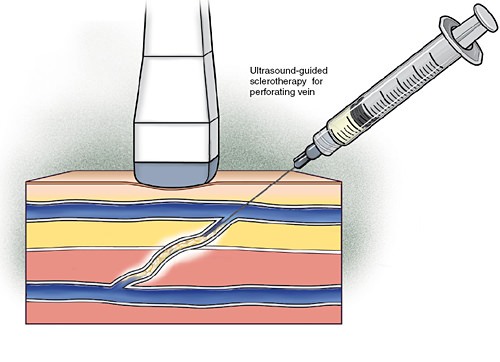 Varicose Vein Treatment: Ultrasound Guided Sclerotherapy in St. Louis