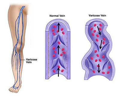 St. Louis Varicose Vein Treatment