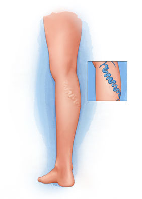 Varicose Veins: St. Louis Vein Treatment & Removal