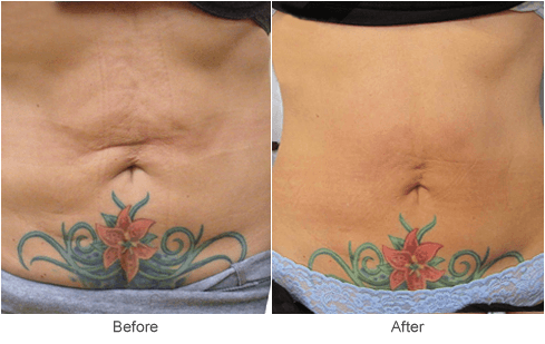 Venus Freeze Skin Tightening Treatment in St. Louis