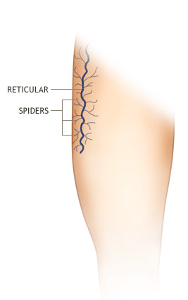 What are Spider Veins